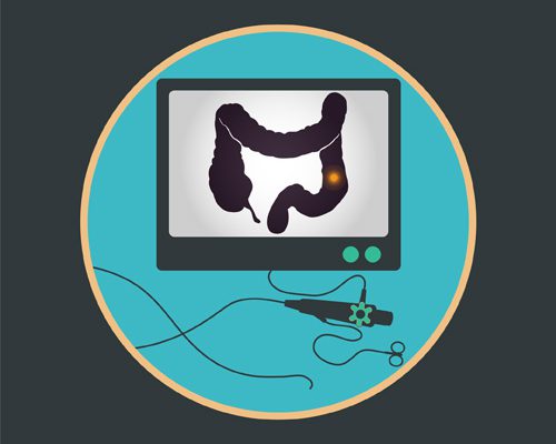 Detección Cáncer de Colon