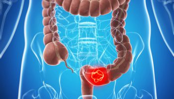 Cancer de Colon y Recto