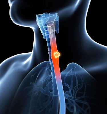 Esophageal Cancer | Dr Isidro Aguilar Montero