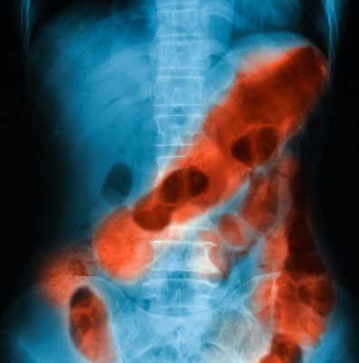 Sangrado tubo digestivo