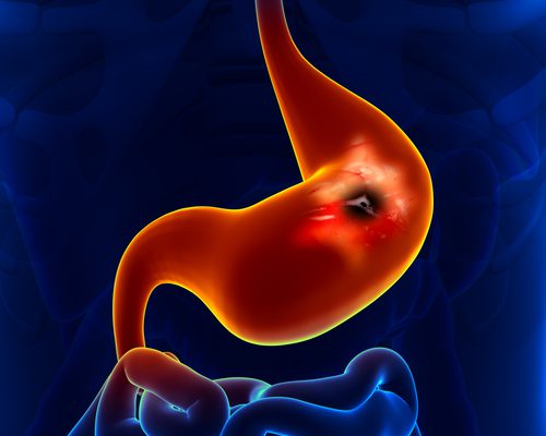Cáncer Gástrico