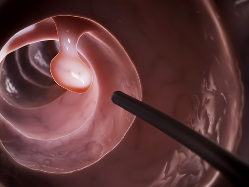 Cirugía Ano Rectal